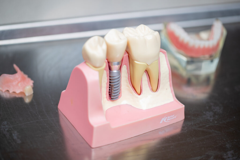 Model of Dental Implants