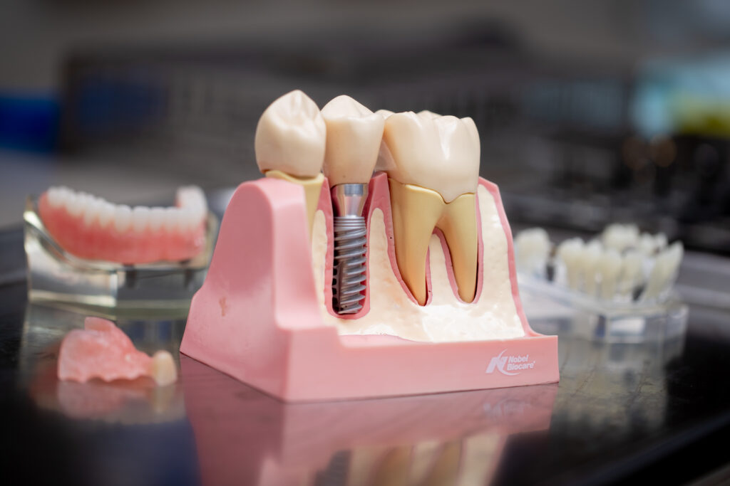 Model of Dental Implants