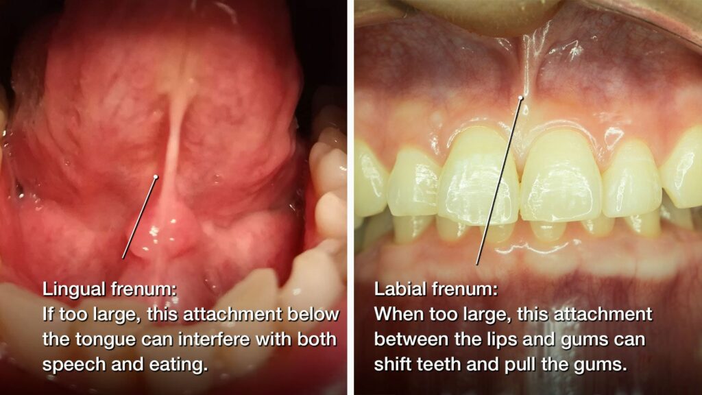 lingual frenulum cut